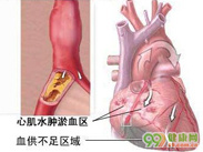 心肌缺血