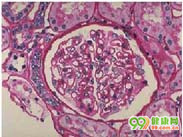 薄肾小球基底膜病